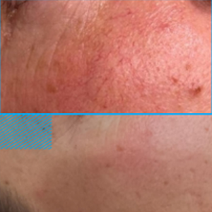 Micro vascularité